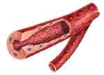 ARTERIA