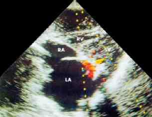 stenosis mitral