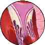 insuficiencia mitral  zoom