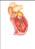 insuf mitral
