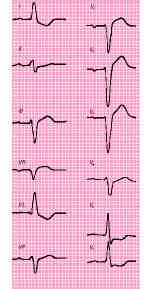 insuficiencia aortica