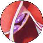 insuficiencia aortica  zoom