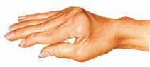mano artritis