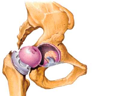 cadera  con ligamento y osteo
