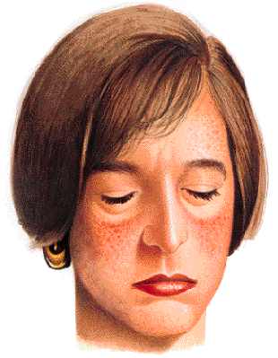 mujer lupus