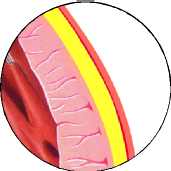PERICARDITIS AGUDA ZOOM