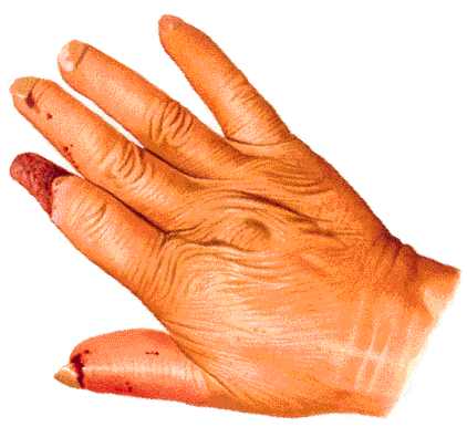 esclerodermia