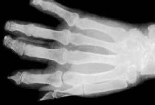 radiograf�a esclerodemia