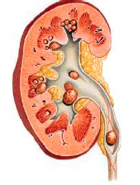litiasis renal
