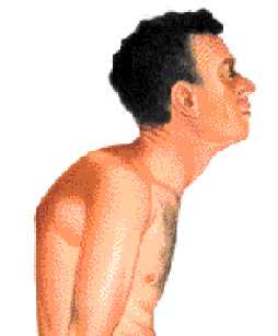 espondilitis anquilosante