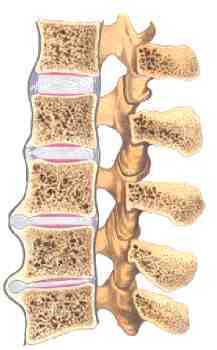 espondilosis deformante