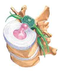 hernia de disco 3