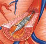 Canastilla intracoronaria