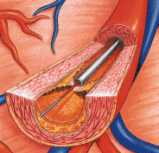 Catter de angioplastia con lser