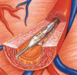 Aterectoma coronaria direccional