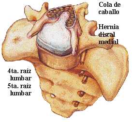Como es curado mucho tiempo poyasnichno kresttsovyy la osteocondrosis
