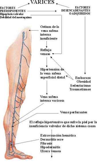 FORO VARICES foro varices: