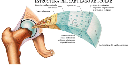 Artrosis