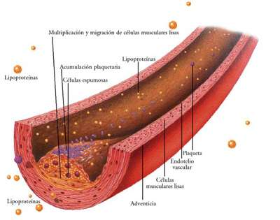 Aterosclerosis