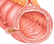 Diverticulitis