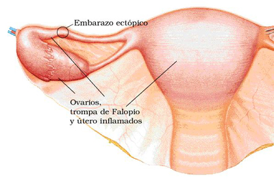 EMBARAZO MATRIZ embarazo matriz: