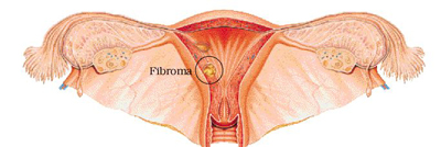 Fibroma