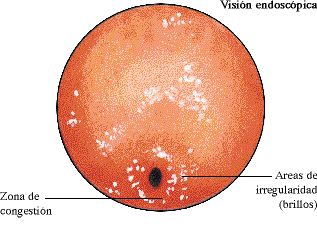 Gastritis