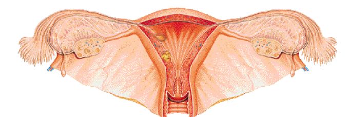 Gonorrea