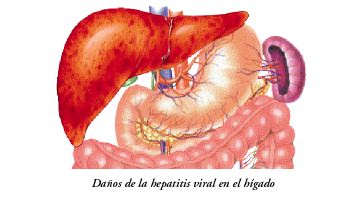 Hepatitis