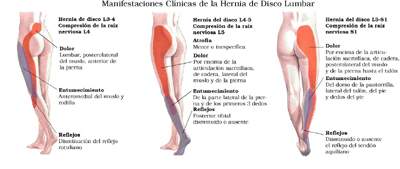 ENFERMEDADES DISCO enfermedades disco: