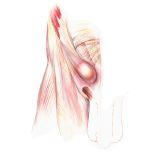Hernia inguinal 	