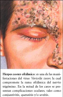 Herpes Zoster