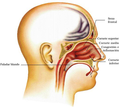 Mononucleosis 	