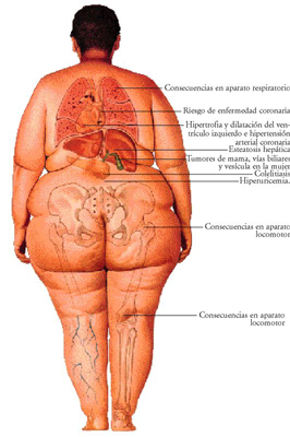 Obesidad
