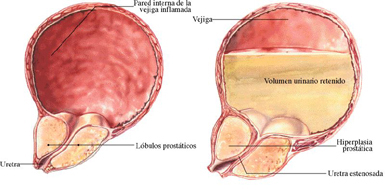 Prostatitis