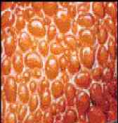 cirrosis laenec