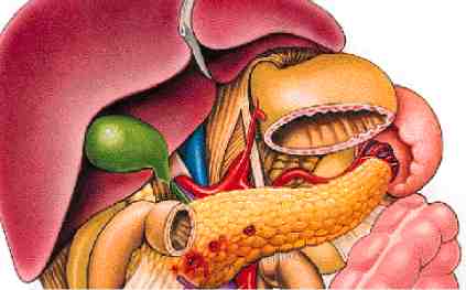 pancreatitis completa