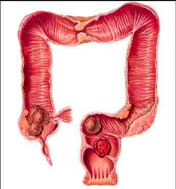 cancer de colon