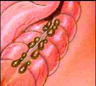 emorragia digestiva