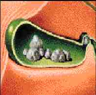 obstruccion intestinal
