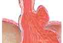 hernia hiat paraesof