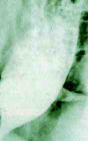 acalasia