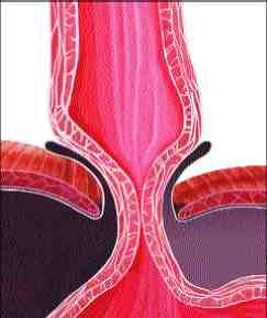 acalasia2