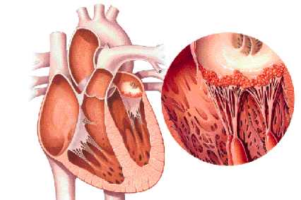 estenosis mitral